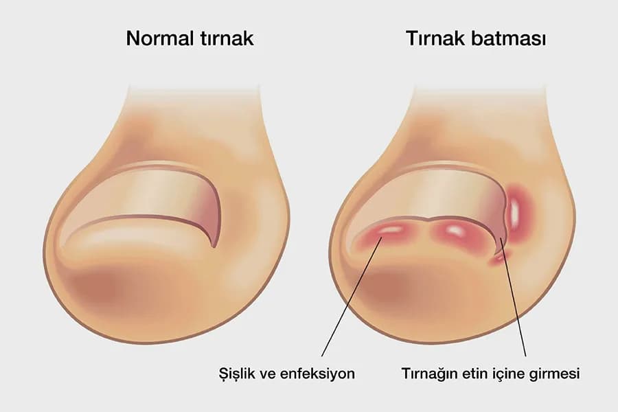 Tırnak Batması